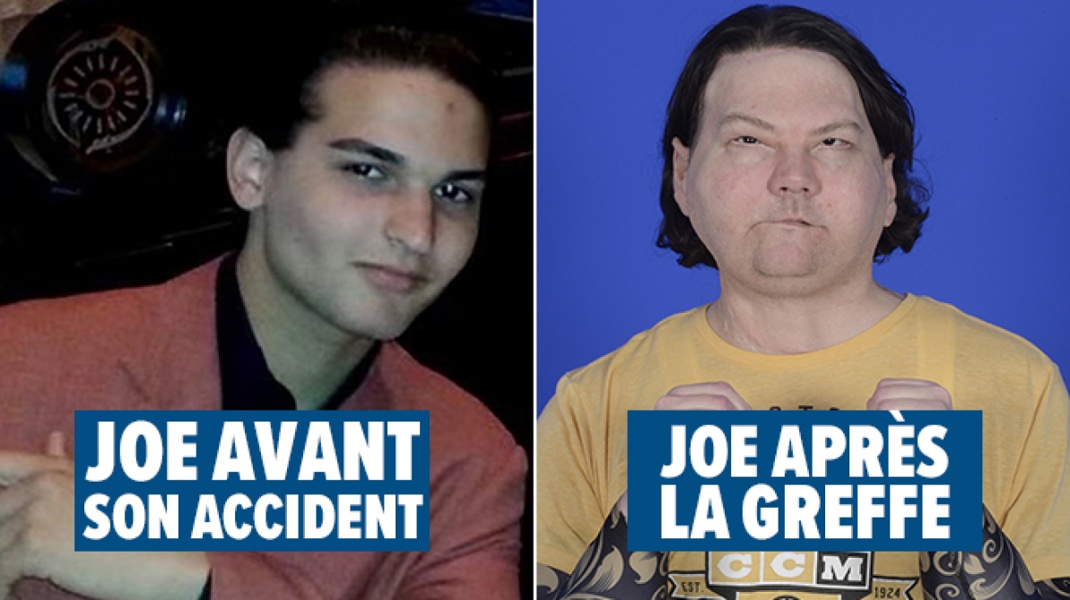 visage brûlé au troisième degré