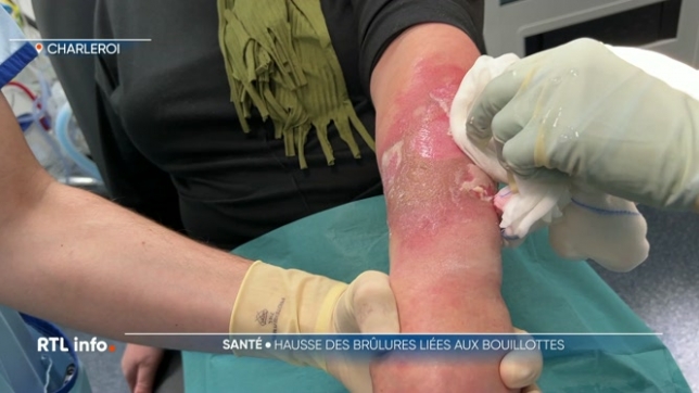 Pour se réchauffer, les bouillottes à l'eau très chaude ou à chauffer au micro-ondes sont à la mode en ce moment. Les urgentistes mettent en garde car il y a énormément de cas de brûlures.