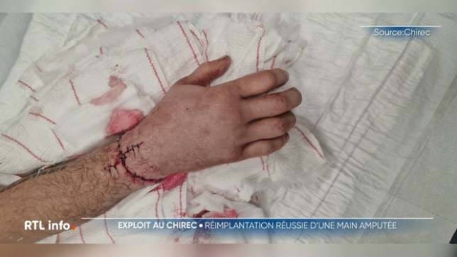 Une opération chirurgicale exceptionnelle a été réalisée à Bruxelles par les équipes médicales du CHIREC. Elles sont parvenues à réimplanter la main d'un patient qui avait été sectionnée par une scie circulaire. Une intervention plutôt rare et toujours longue et délicate à réaliser.