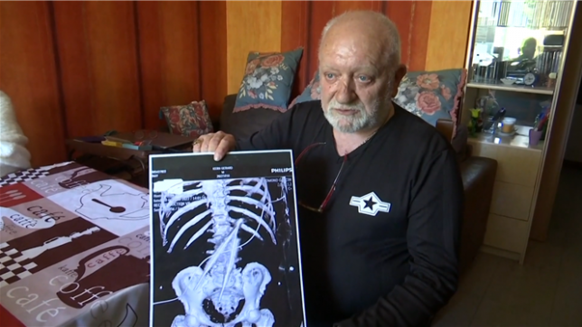 Ça me lançait, ça me tirait…: une pince chirurgicale a été oubliée dans le corps de Gérard, 68 ans, pendant une opération