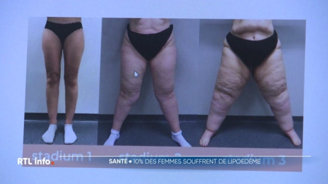 Le lipœdème touche entre 10 et 11% des femmes en Belgique. Il s'agit d'une accumulation anormale de graisse sous la peau, souvent diagnostiquée après des années de souffrance. Des traitements lourds et une hygiène de vie irréprochable sont nécessaires pour limiter sa progression.