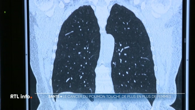 Le cancer du poumon est le 2e cancer le plus fréquent chez les Belges. L'année dernière, en 2024, cette maladie a touché pour la première fois davantage de femmes que d'hommes. C'est aussi l'un des cancers dont les chances de survie sont les moins élevées.