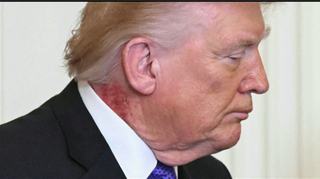 Donald Trump est apparu lundi pour une cérémonie à la Maison Blanche avec une plaque rougeâtre bien visible dans le cou, due selon son médecin à l'application d'un traitement préventif.