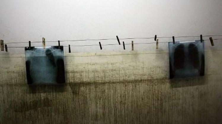 Action Damien craint un nombre croissant de cas de tuberculose et de lèpre