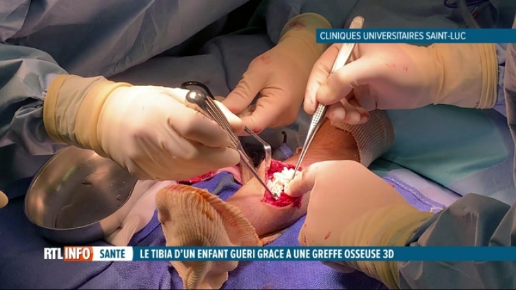 Le tibia d'un enfant a été guéri grâce à une greffe osseuse 3D