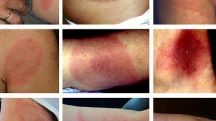 tiques-corps-article