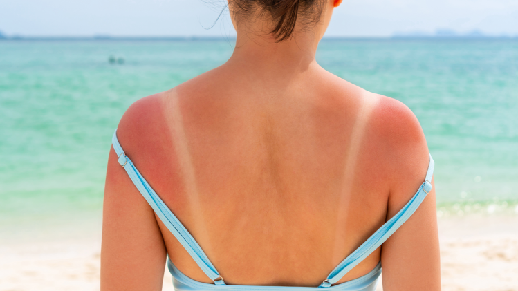 Cancer de la peau, coup de soleil