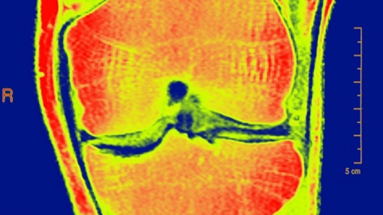 Des exercices quotidiens pour améliorer ses muscles et prévenir l'arthrose