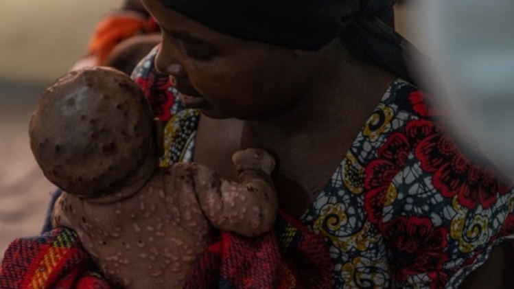 Au Burundi, un tiers des malades du mpox a moins de 5 ans, selon l'ONU