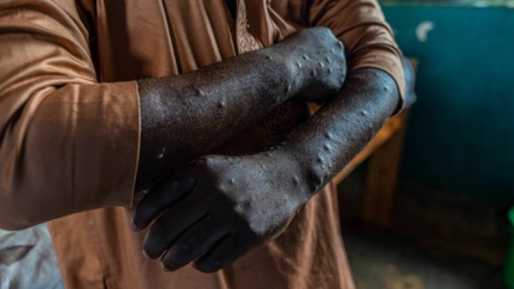 Mpox: 1.100 décès en Afrique, mise en garde de l'agence sanitaire de l'UA