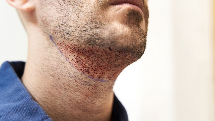 "N'allez surtout pas là-bas": un jeune Français se suicide après une greffe de barbe ratée en Turquie