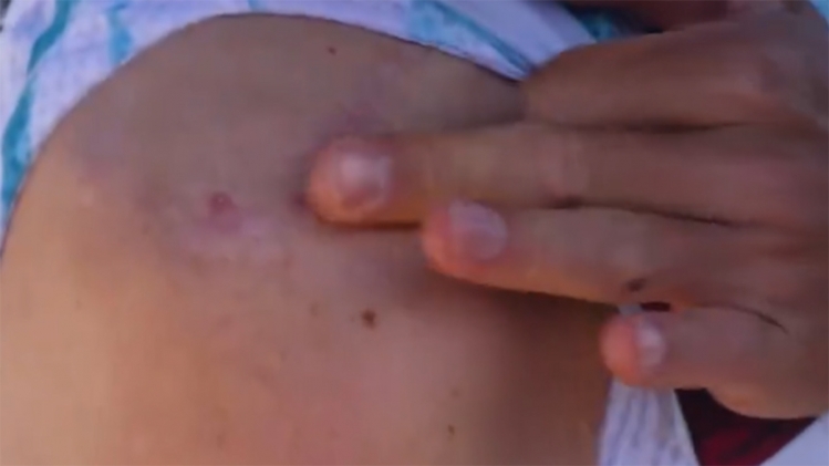 remco_evenepoel_cicatrice