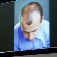 Les dermatologues observent une augmentation de 15 à 20% des consultations chez les jeunes pour la perte des cheveux