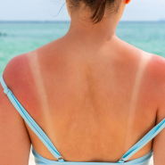 Cancer de la peau, coup de soleil