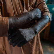 Mpox: 1.100 décès en Afrique, mise en garde de l'agence sanitaire de l'UA