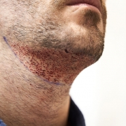 "N'allez surtout pas là-bas": un jeune Français se suicide après une greffe de barbe ratée en Turquie