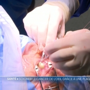 130 Belges sont diagnostiqués en moyenne chaque année en Belgique. Les Cliniques universitaires Saint-Luc proposent un traitement unique en Belgique : la pose d'une plaque en or contenant de l'iode radioactive implantée dans l'oeil pendant 4 jours. Explications.