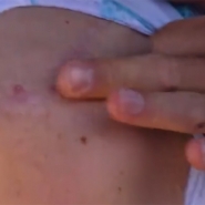 remco_evenepoel_cicatrice